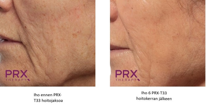 PRX-T33® Biorevitalisaatio